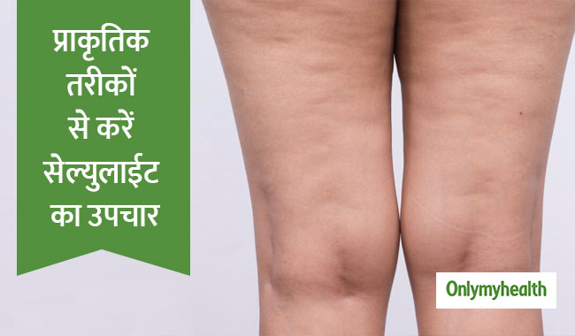 सेल्युलाईट रोग बिगाड़ देता है महिलाओं की खूबसू‍रती, जानें कारण और प्राकृतिक उपचार