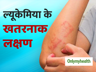 ल्यूकेमिया होने पर शरीर में दिखते हैं ऐसे लक्षण, समय रहते शुरू कर दें इलाज