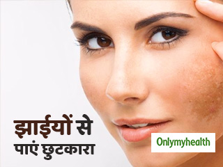 प्रेग्नेंसी में आई चेहरे की झाईयों को तुरंत दूर करता है ये उपाय, जानें अभी