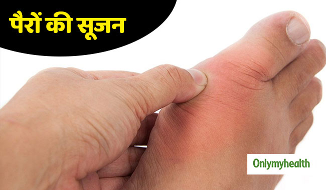 पैरों में कई दिनों तक सूजन हो तो न करें नजरअंदाज, इन 5 बीमारियों का हो सकता है संकेत