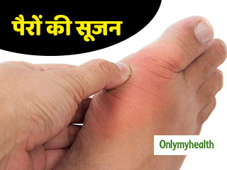 पैरों में कई दिनों तक सूजन हो तो न करें नजरअंदाज, इन 5 बीमारियों का हो सकता है संकेत