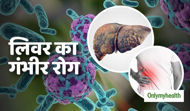 लिवर को खराब कर सकता है हेपेटाइटिस रोग, जानें कैसे कर सकते हैं बचाव और इलाज