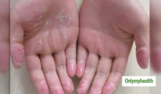 Home Remedy to Get Rid of Hand Skin Peeling