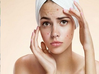 मुंहासों को 5 दिन में आसानी से ठीक करते हैं पान के पत्ते, जानें कैसे