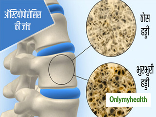 ऑस्टियोपोरोसिस के मरीजों के लिए जरूरी हैं ये 3 जांच, जानें खास बातें