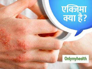 एक्जिमा क्‍या है, जानें इसके लक्षण और उपचार