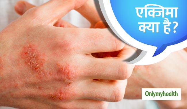 एक्जिमा क्‍या है, जानें इसके लक्षण और उपचार