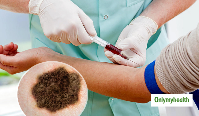 a-blood-test-might-detect-melanoma-skin-cancer-study-onlymyhealth