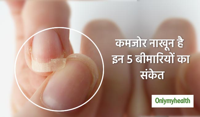 नाखूनों का कमजोर होकर जल्दी टूटना भी है कई बीमारियों का लक्षण