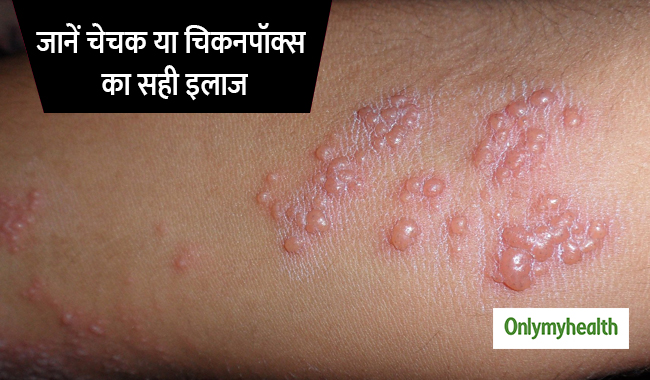 इस विषाणु के कारण फैलता है चेचक, जानें क्या है सही इलाज