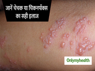 इस विषाणु के कारण फैलता है चेचक, जानें क्या है सही इलाज