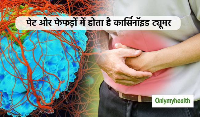 खतरनाक रोग है कार्सिनॉइड ट्यूमर, कैंसर जैसे होते हैं लक्षण