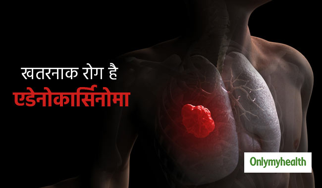 लंग्स कैंसर की शुरुआत है एडेनोकार्सिनोमा रोग, ये हैं लक्षण और कारण