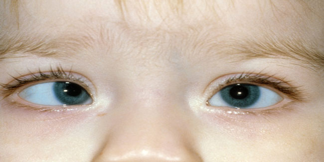 क्‍या है आंखों का भेंगापन? जानें इसके लक्षण, कारण और उपचार