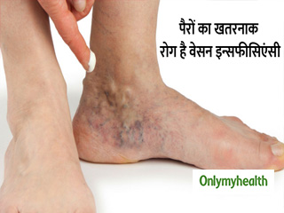 पैरों में संक्रमण का कारण हो सकता है वेनस इन्सफीसिएंसी, जानें खतरे