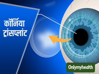 World Sight Day 2019: आंखों की रोशनी कम हो रही है तो कराएं कॉर्निया ट्रांसप्‍लांट, पहले से तेज होगी नजर