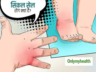 आनुवांशिक कारणों से होता है सिकल सेल रोग, जानें बचाव का तरीका  