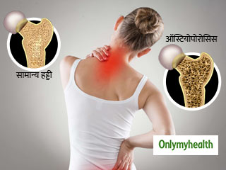आखिर महिलाओं को क्यों होती है ऑस्टियोपोरोसिस की अधिक समस्या, जानें पूरा सच