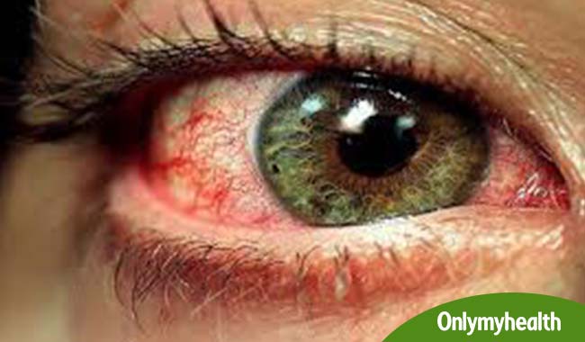 आंखों की खतरनाक बीमारी हैं मैक्यूलर डिजनेरेशन, जानें इसके लक्षण 