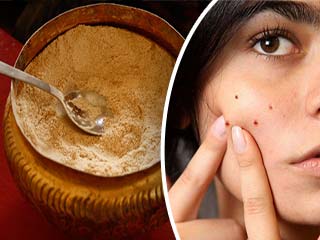 पिंपल्स होने पर लगाएं ये घरेलू चीज, निशान का भी होगा जड़ से सफाया