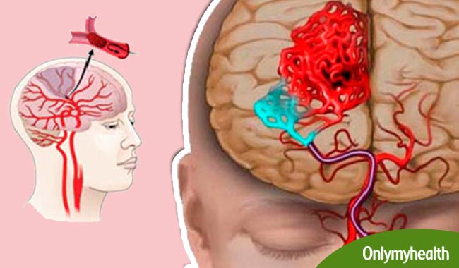 ब्रेन अटैक के होते हैं ये सामान्य लक्षण, एफएएसटी करें और बचाएं जान