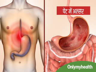 पेट में छाले (अल्सर) का संकेत हैं शरीर में दिखने वाले ये 5 बदलाव, लक्षण हैं तो डॉक्टर से मिलकर शुरू करें इलाज