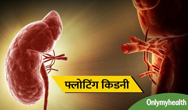 गुर्दे का सरकना यानि 'फ्लोटिंग किडनी' के ये हैं लक्षण और कारण