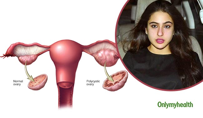 सारा अली खान भी हैं पीसीओडी की मरीज, जानें इसके लक्षण और बचाव