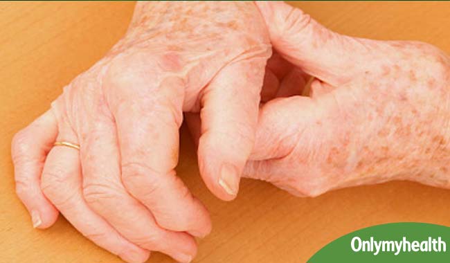 विश्व अर्थराइटिस दिवस: क्‍या है गठिया रोग, जानें लक्षण और उपचार