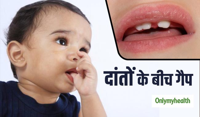 अंगूठा चूसने से बच्चों के दांतों में हो जाता है गैप, ऐसे छुड़ाएं आदत
