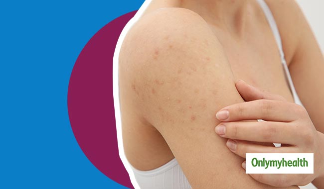 7 Effective Ways to Get Rid of Back and Shoulder Acne