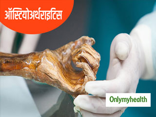ऑस्टियोअर्थराइटिस के बारे में आज ही दूर करें ये 5 भ्रांतियां, हड्डियां रहेंगी सुरक्षित