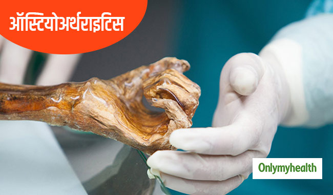 ऑस्टियोअर्थराइटिस के बारे में आज ही दूर करें ये 5 भ्रांतियां, हड्डियां रहेंगी सुरक्षित