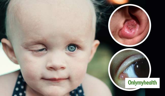 World Health Day 2020: मांसपेशियों का कैंसर है  रैबडोमायोसरकोमा, 20 से कम उम्र के बच्‍चों को करता है प्रभावित 