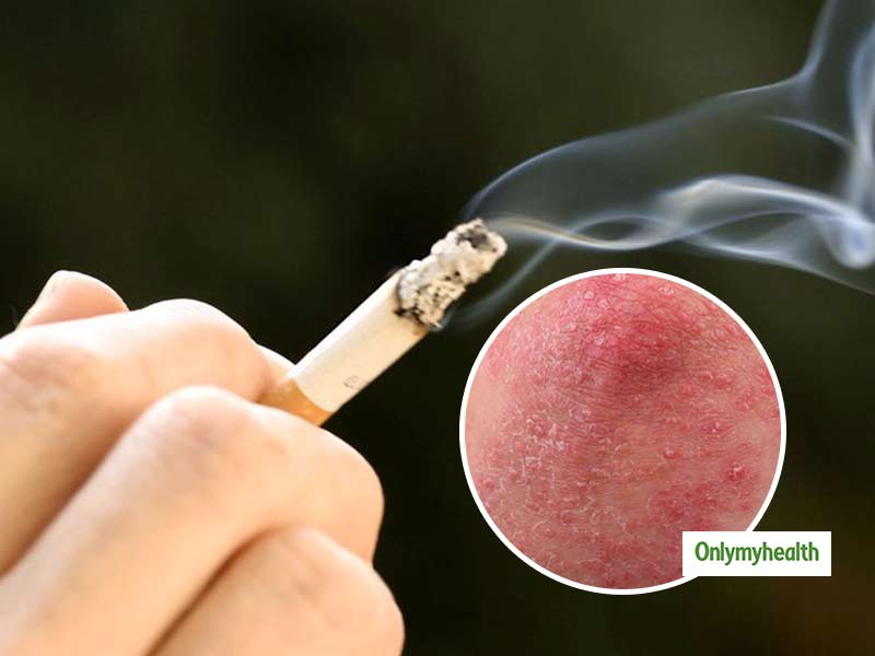 धूम्रपान करने से बढ़ सकता है सोराइसिस का खतरा, जानें लक्षण और इलाज