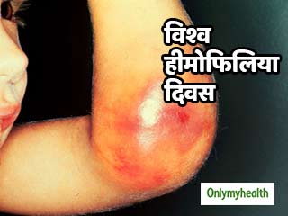 World Hemophilia Day: दो प्रकार के होते हैं हीमोफीलिया रोग, जानें क्‍या है हीमोफीलिया बी