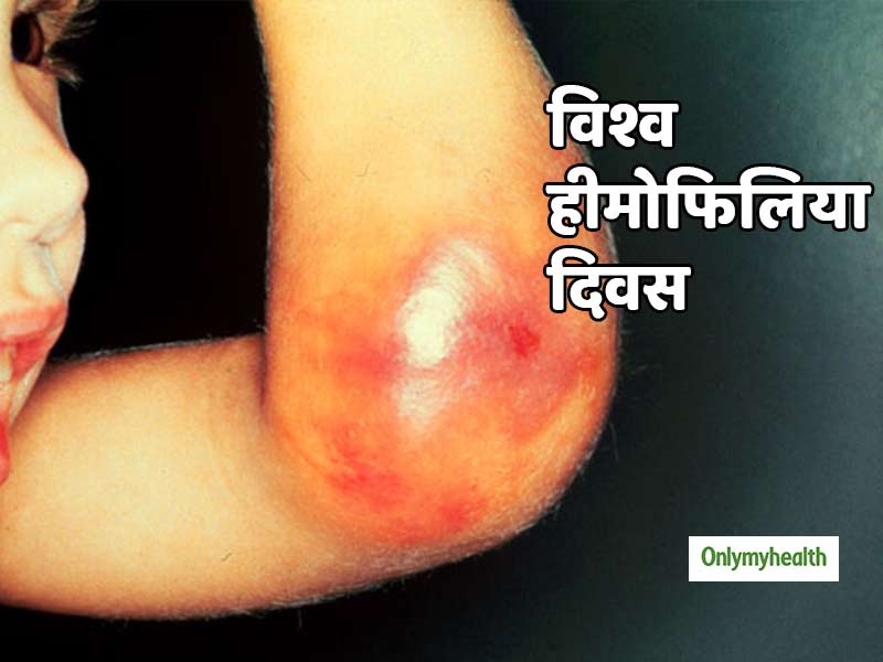 World Hemophilia Day: पुरुषों में ज्‍यादा क्‍यों होती है हीमोफिलिया की समस्‍या, जानें कारण और बचाव