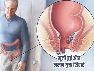 बवासीर के इलाज के लिए आई नई सर्जरी, जड़ से खत्म करेगी रोग