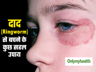 Ringworm: दाद क्या है? जाने इसके प्रकार, लक्षण और इससे बचने के कुछ सरल उपाय