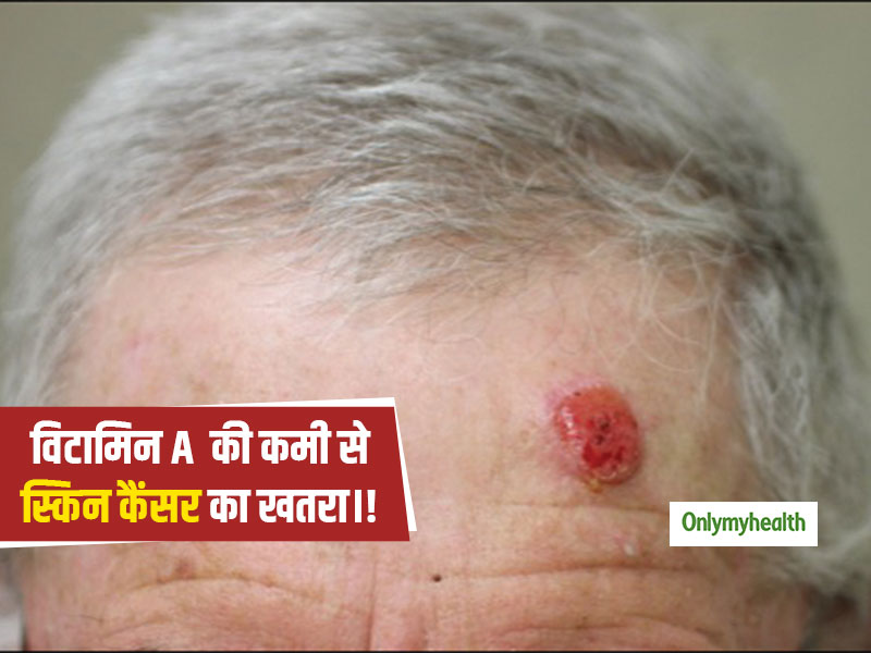 Skin Cancer: विटामिन A के सेवन से नहीं होता स्किन कैंसर- वैज्ञानिकों ने किया दावा, जानें विटामिन A के स्‍त्रोत 