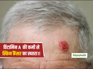 Skin Cancer: विटामिन A के सेवन से नहीं होता स्किन कैंसर- वैज्ञानिकों ने किया दावा, जानें विटामिन A के स्‍त्रोत 