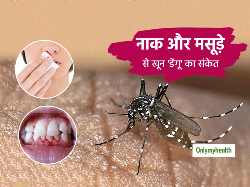 नाक और मसूढ़ों से खून आना भी है डेंगू बुखार का एक संकेत, जानें डेंगू रक्तस्रावी ज्वर के अन्य लक्षण