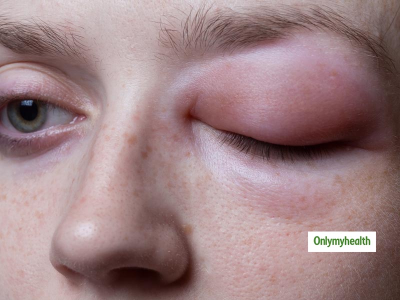 Remedies For Puffy Eyes: एक बार आजमा कर तो देखें ये तरीका, सूजी हुई आंखें तुरंत होंगी नॉर्मल