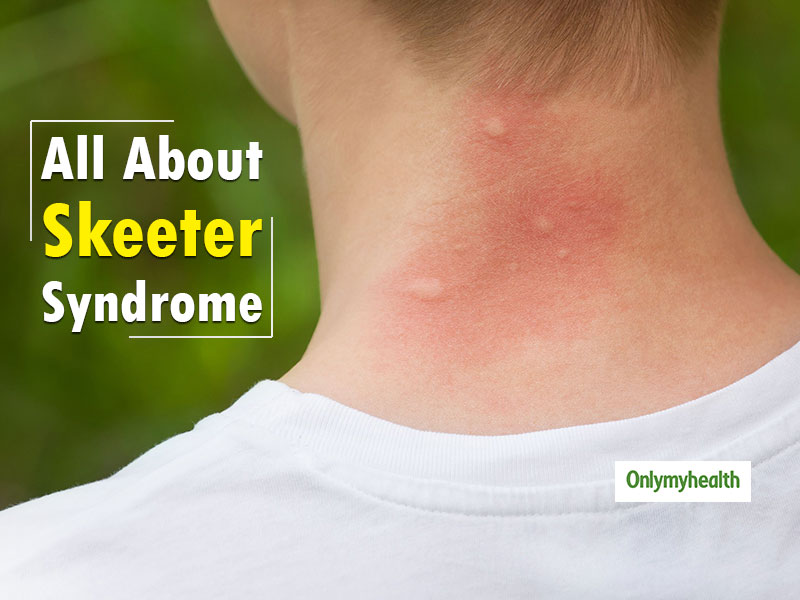 Know About Skeeter Syndrome: Allergic Reaction To Mosquito ...