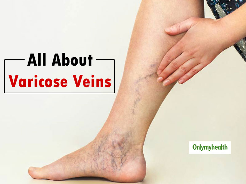 Treat Varicose Veins On Time To Avoid Serious Complications