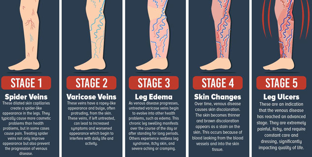 Treat Varicose Veins On Time To Avoid Serious Complications