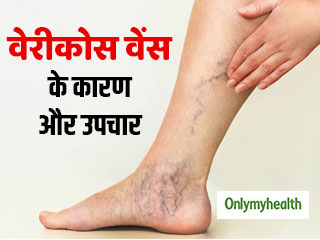 Varicose Veins: पैरों की ऊभरी और मुड़ी हुई नसें हार्मोनल असंतुलन के हैं संकेत, जानें बचाव और उपचार 