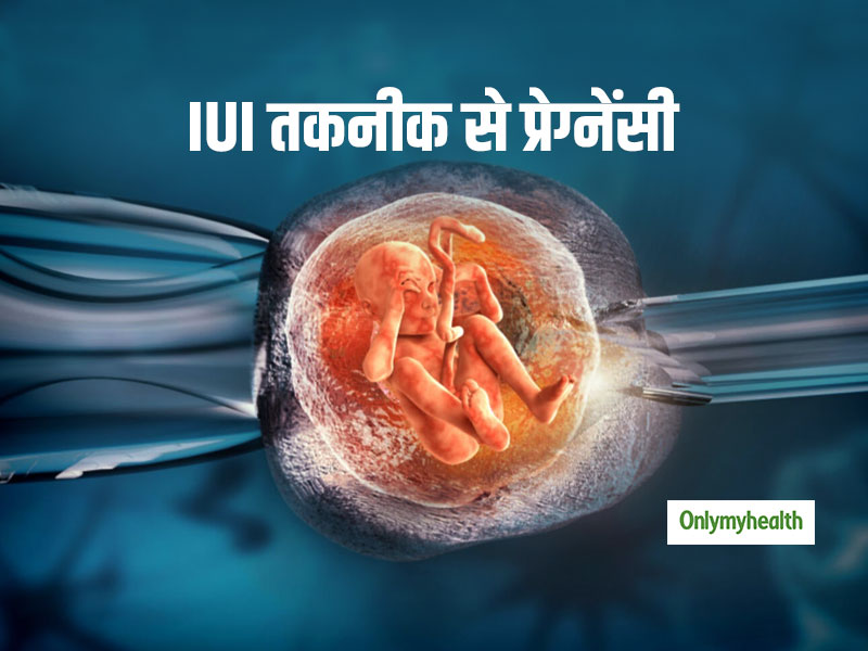 आईयूआई (IUI) से गर्भवती होने की कितनी संभावना होती है? पढ़ें आज इस बारे में सबकुछ
