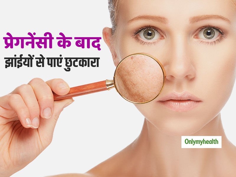 Post Pregnancy Skin Care: डिलीवरी के बाद आम है झाईयों और मुंहासों की समस्या, ये तरीका है सबका रामबाण