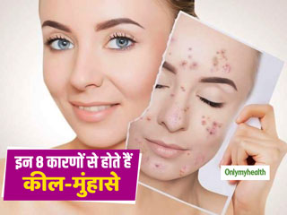 इन 8 कारणों से होते हैं चेहरे पर कील-मुंहासे, जानें इन्हें दूर करने के आसान उपाय  